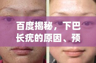 百度揭秘，下巴长疣的原因、预防与治疗策略一网打尽